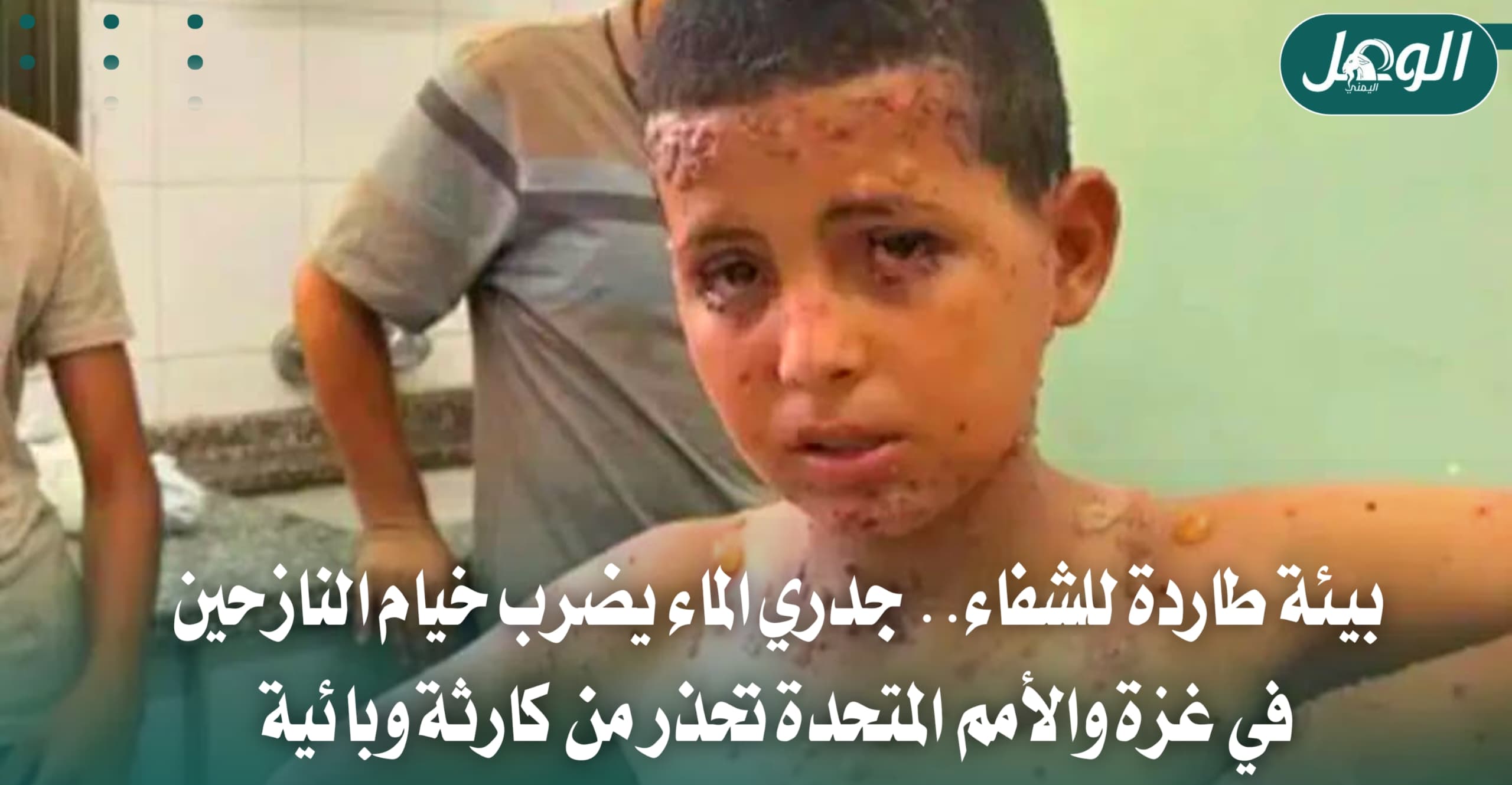 الأمم المتحدة تحذر من تفشي جدري الماء في غزة بعد تسجيل 9300 إصابة خلال أسبوعين